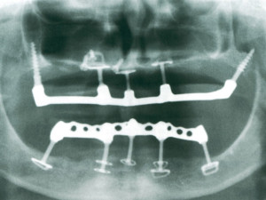 BOI zubný bazálny implantát pri nedostatku kosti príklad aplikácie Stomaklinik